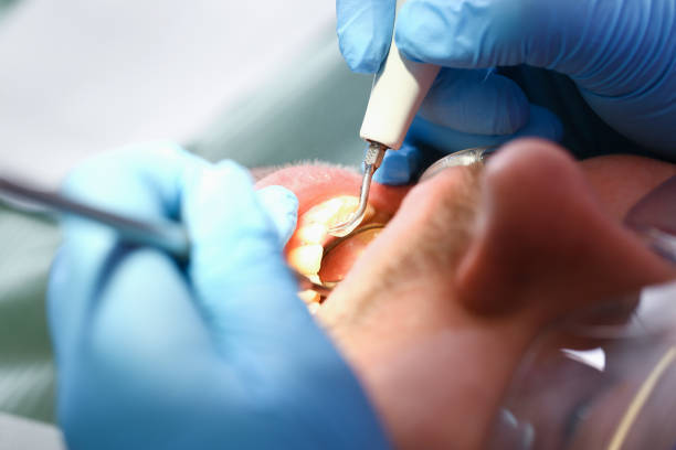 Best Emergency Treatment for Dental Infections or Abscesses in Burbank, WA